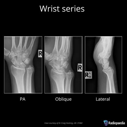 If a single view of wrist x-ray is performed then append modifier 52 (Reduced service) with CPT 73100 (Because of CPT code description states it's 2 views). . Cpt code for x ray wrist 3 views
